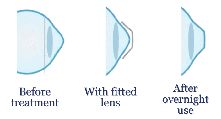 This diagram shows how Ortho-K lenses gently shape the cornea overnight.  